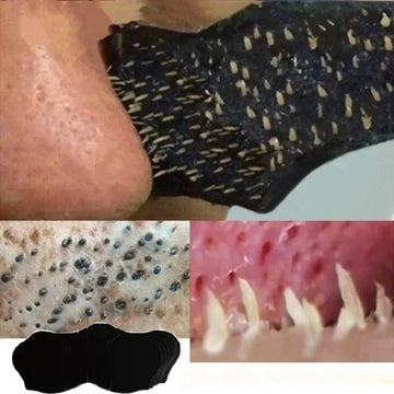 Blackhead Removal Nasal Strips – Instant Deep Pore Cleansing